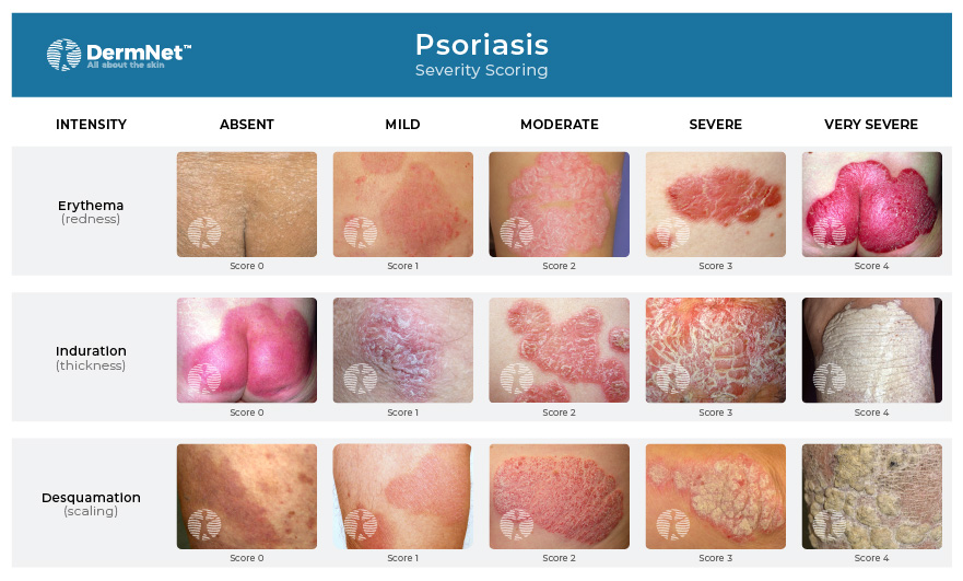 Psoriasis Severity Scoring - PASI