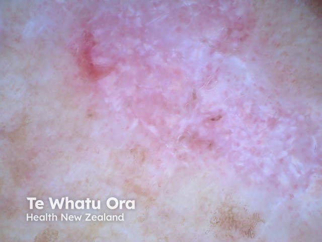 Intraepidermal carcinoma, polarised dermoscopy view