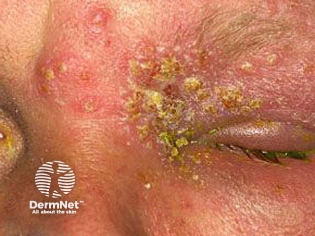 Herpes simplex