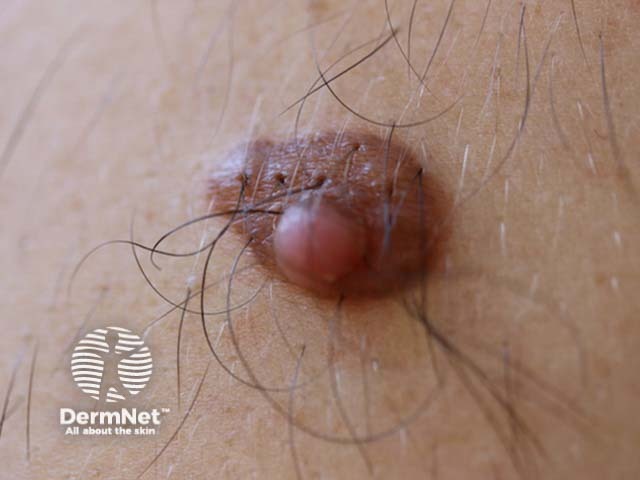 supernumerary nipple