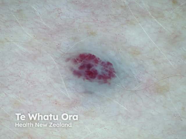 Cherry angioma 8 dermoscopic