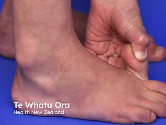 Ehlers-Danlos syndrome