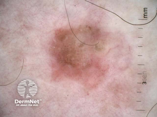 Pigmented intraepidermal carcinoma dermoscopy