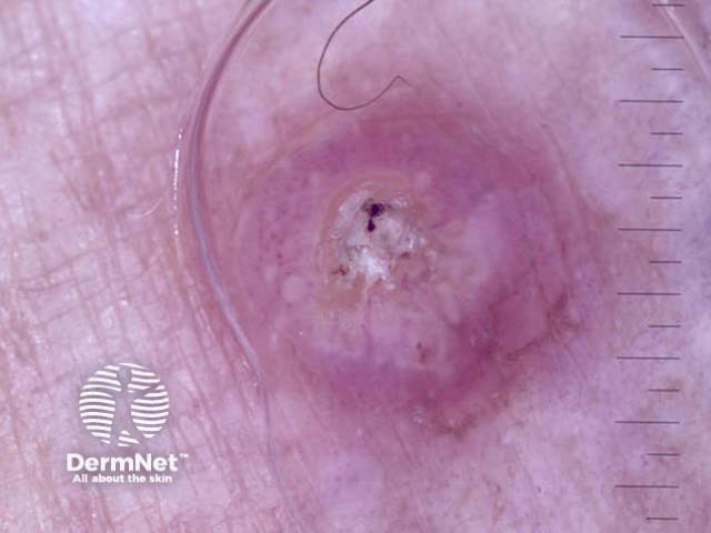Invasive squamous cell carcinoma nonpolarised dermoscopy view