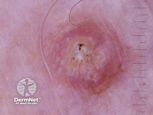 Invasive squamous cell carcinoma, polarised dermoscopy view