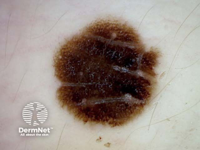 Reed naevus 5 dermoscopy