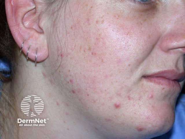 Adult acne