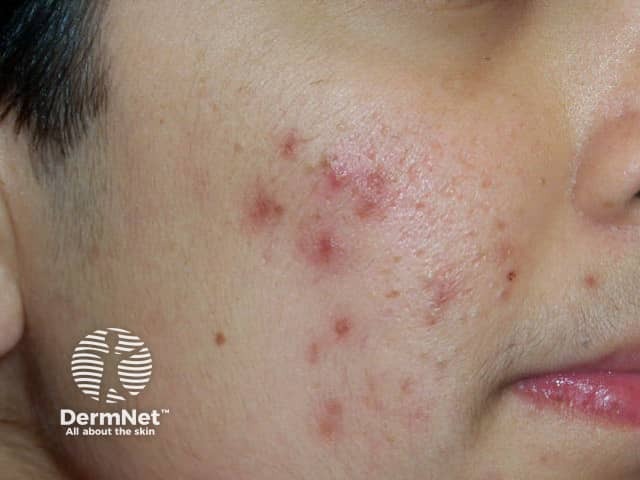 Comedonal and papulopustular acne suitable for clascoterone therapy