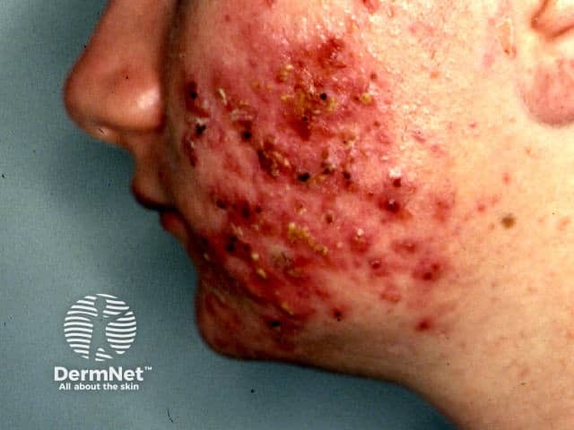 Gram negative folliculitis