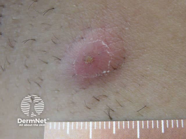 An acute painful inflammatory nodule in axillary HS