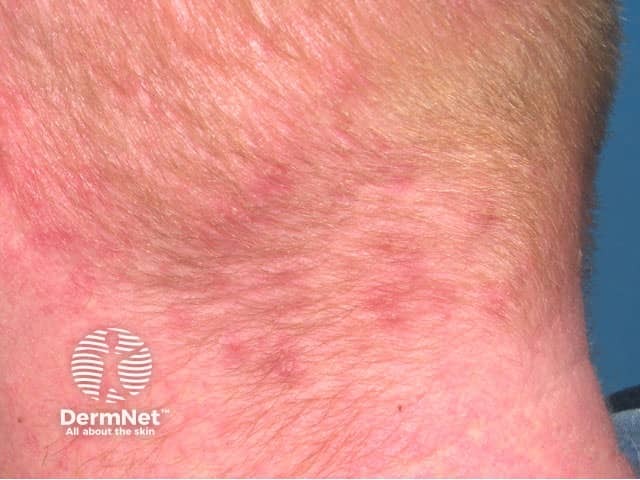 Scalp folliculitis