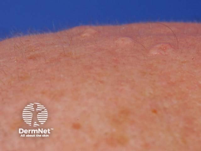 Sebaceous hyperplasia