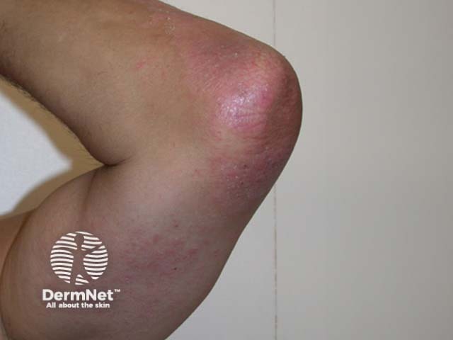 Spa pool folliculitis