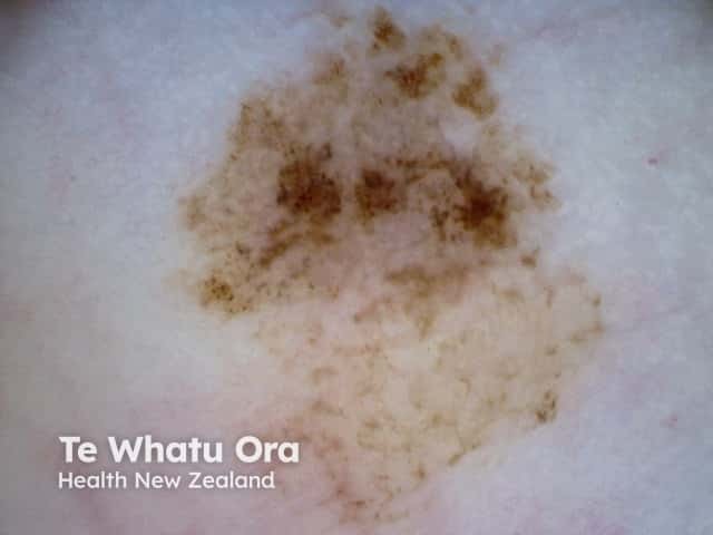 Acral lentiginous melanoma 3 dermoscopy