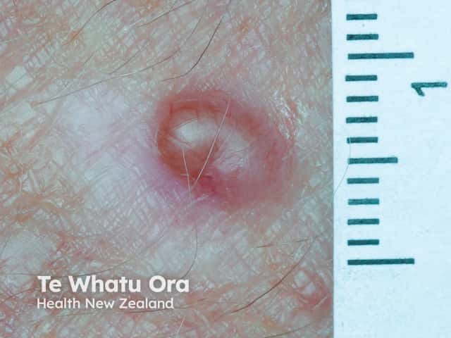 L arm melanoma? BCC?