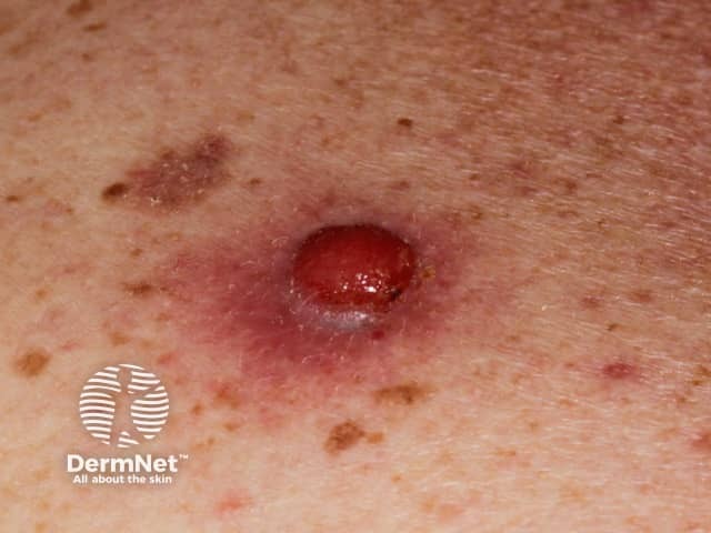 Nodular melanoma