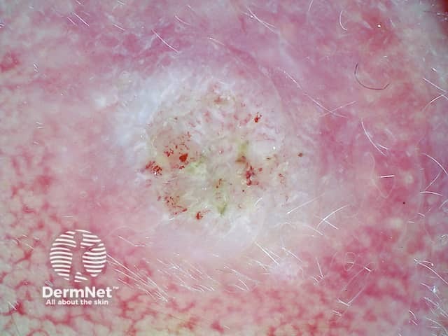 Amelanotic superficial spreading melanoma dermoscopy