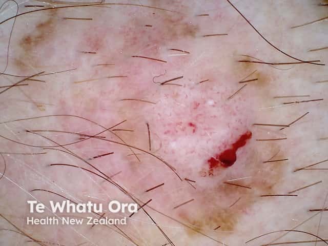 Amelanotic superficial spreading melanoma dermoscopy