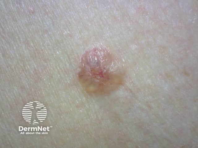 Basal cell carcinoma affecting the arms and legs 5 macro