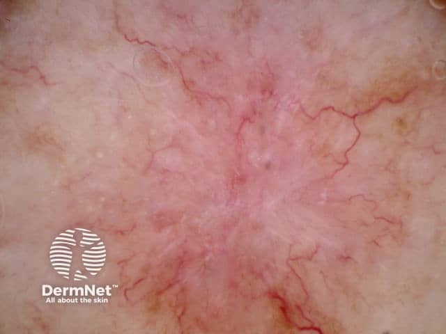 Basal cell carcinoma dermoscopy