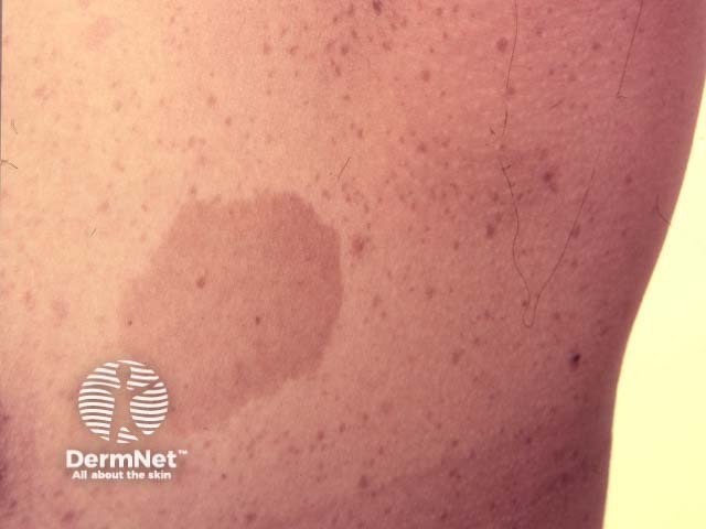 Café au lait macule