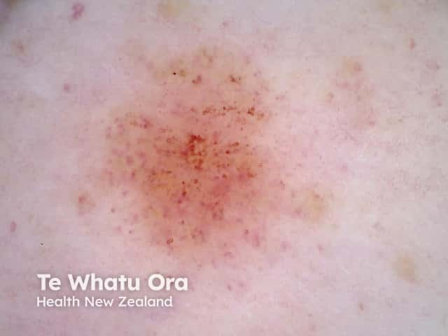 Dermoscopy of capillaritis