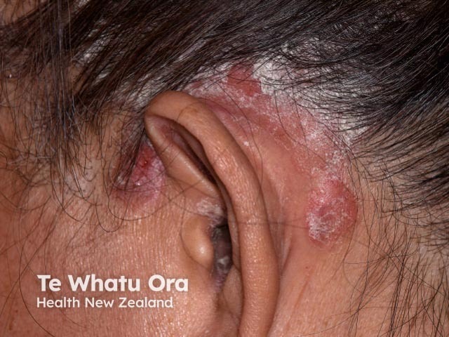 Chronic plaque psoriasis
