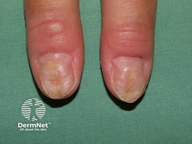 Habit-tic deformity in thumbnails