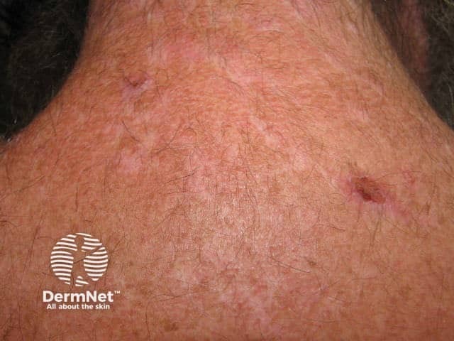 Compulsive skin picking