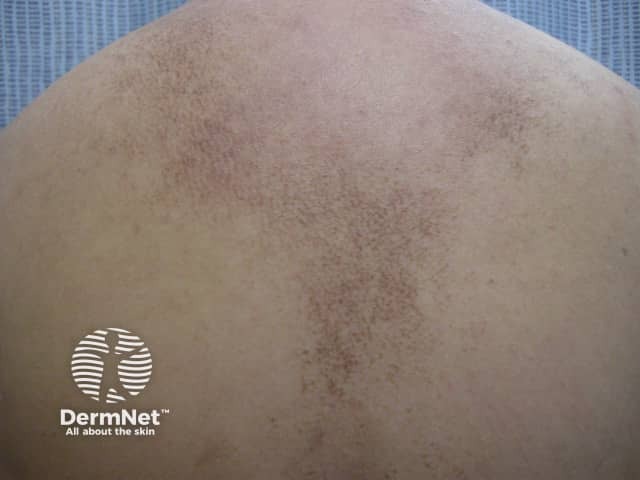 Confluent and reticulated papillomatosis