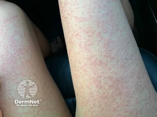 Suspected COVID-19 rash
