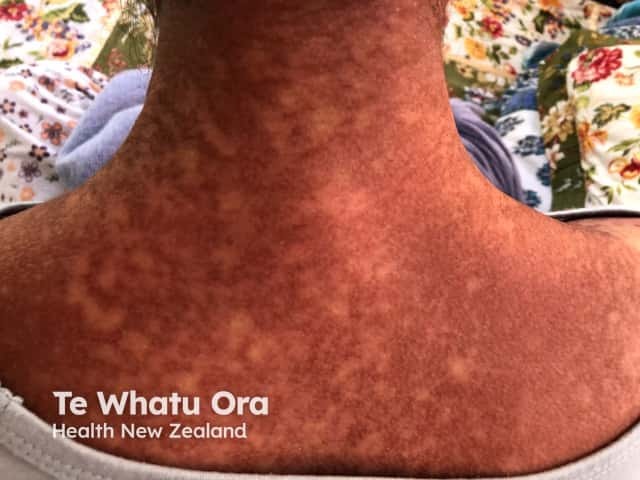Suspected COVID-19 rash