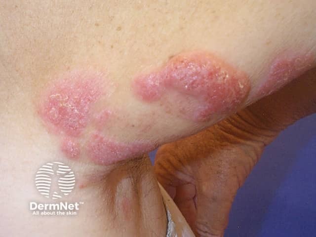 Mycosis fungoides