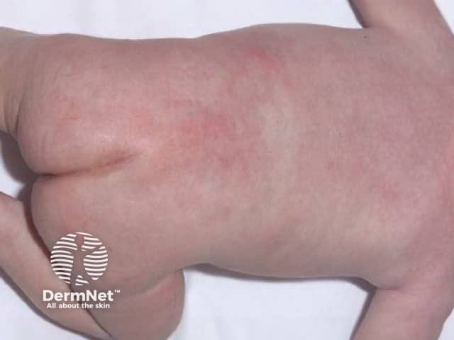 Indurated plaques on the back of a newborn due to SCFN