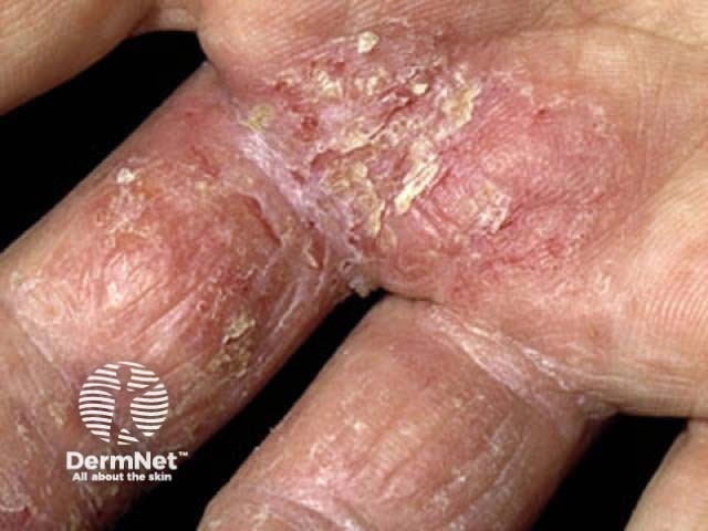 Hand dermatitis