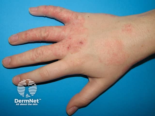Hand dermatitis