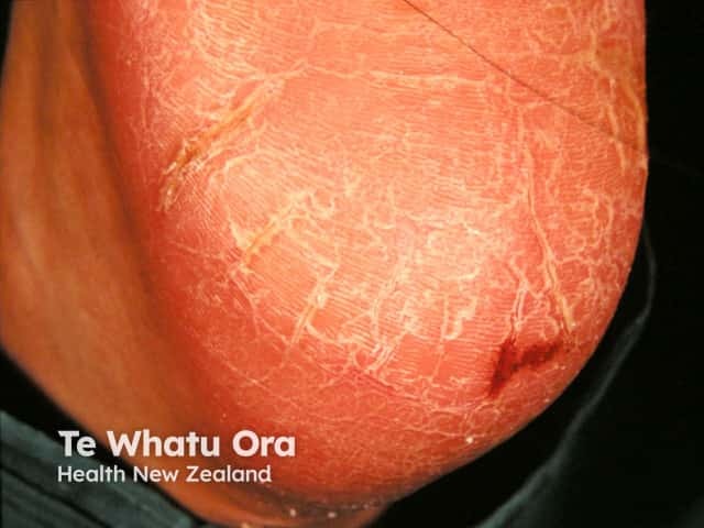 Juvenile plantar dermatosis