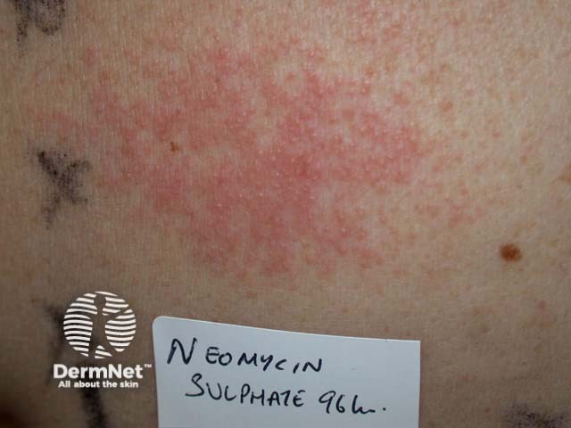 Patch test ++ reaction to neomycin