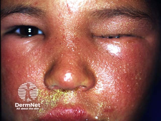 Toxicodendron dermatitis