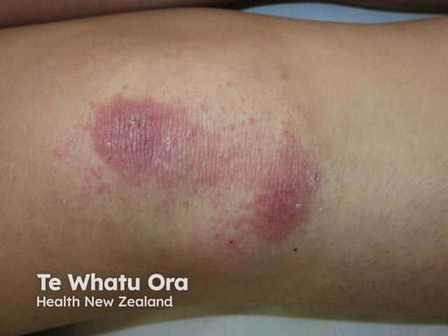 Gottron sign over a knee