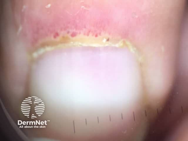 Dermatomyositis of the nailfold