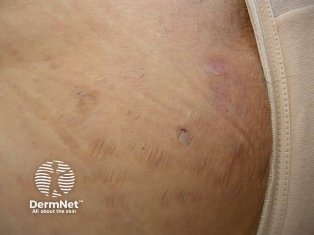 Hidradenitis suppurativa