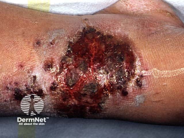 Impetiginised eczema