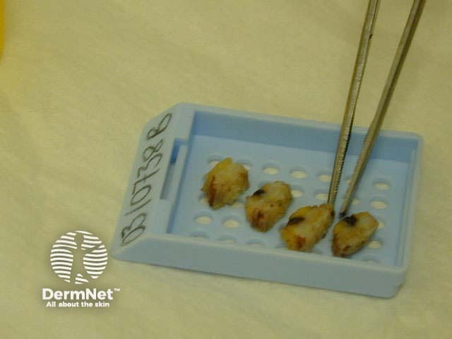 Skin fragments in cassette