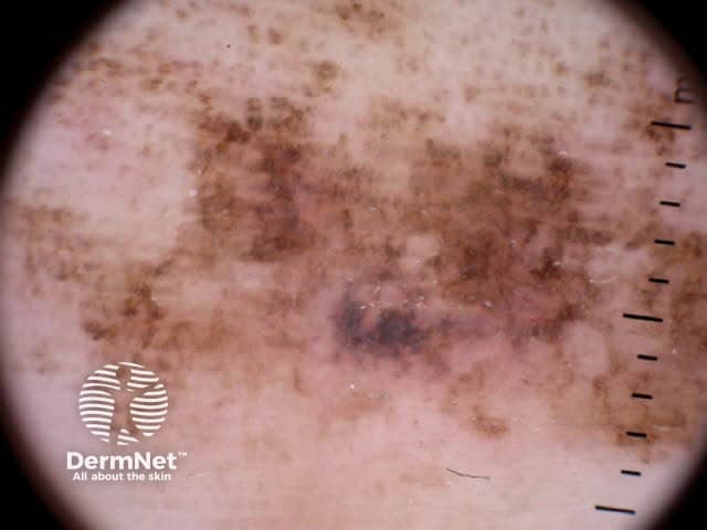 Parallel ridge pattern, asymmetrical structure and diffuse pigmentation