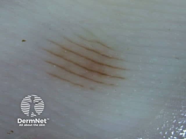 Parallel furrow pattern BRAAF -1