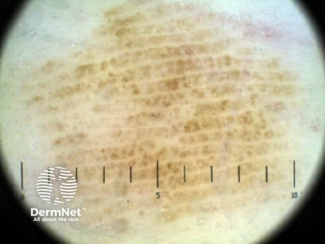 Dermoscopy of acral naevus showing parallel ridge pattern