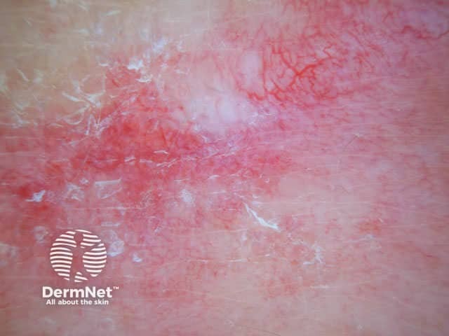 White structureless area, linear irregular vessels