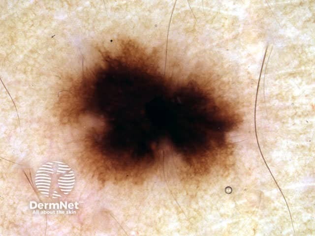 Central hyperpigmentation