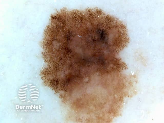 Asymmetry, 3 colours